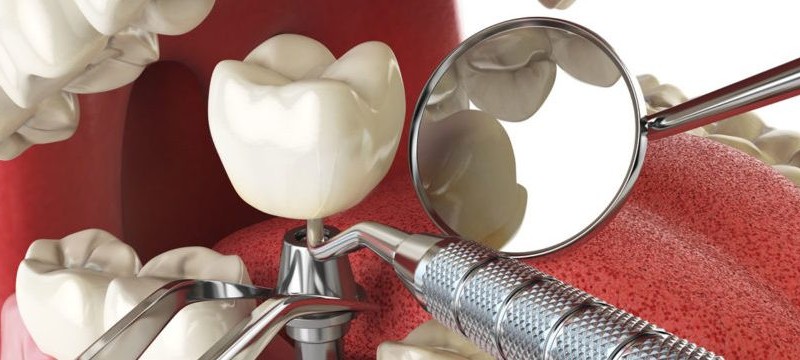 Cat-dureaza-un-implant-dentar2-825x360